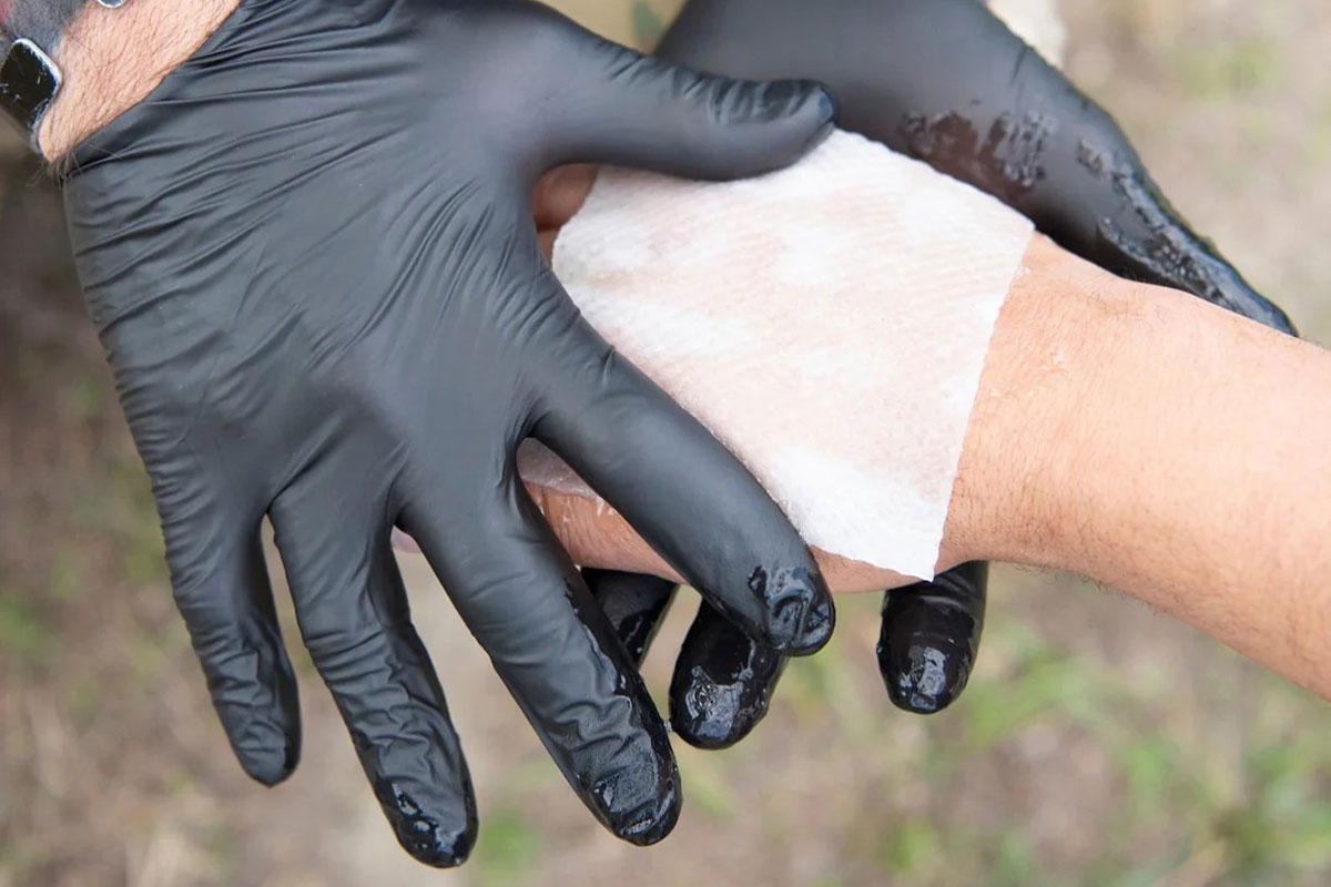 Safeguard Medical Water-Jel Burn Dressings